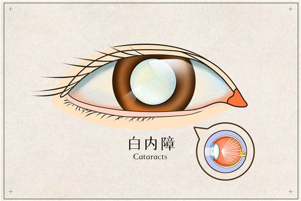 摄图网_401789645_白内障医疗插画(企业商用)_副本.jpg